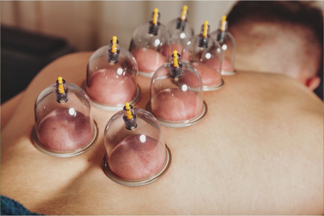 cupping, Austin Shellnut, Athletic Edge Physical Therapy, Grovetown, GA